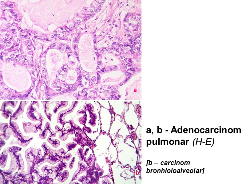 a, b - Adenocarcinom pulmonar (H-E)  [b – carcinom bronhioloalveolar] a b